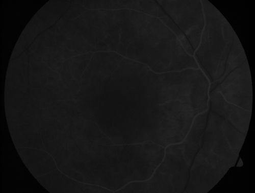 Peripapillary Lesion Hemangioma or CNVM Very Early FA
67-year-old man with a history of a peripapillary lesion in the right eye.  
Keywords: peripapillary;hemangioma;unknown