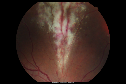 Acute Cytomegalovirus Retinitis
45 y/o male presents with newly diagnosed AIDS and retinal infiltrates.
Keywords: CMV;Cytomegalovirsus;Retinitis