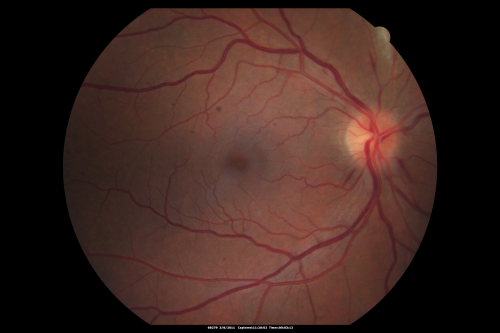 Acute Cytomegalovirus Retinitis
45 y/o male presents with newly diagnosed AIDS and retinal infiltrates.
Keywords: CMV;Cytomegalovirsus;Retinitis