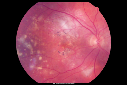 Polypoidal Choroidal Vasculopathy Right Eye - Disciform Scar Left Eye
84-year-old woman has polypoidal choroidal vasculopathy in both eyes with macular degeneration.  She has macular scars in both eyes and she remains with remarkably good vision in the right eye despite the scarring.  

VISUAL ACUITY:  OD 20/30,  OS 1/200

Avastin Rx OD
