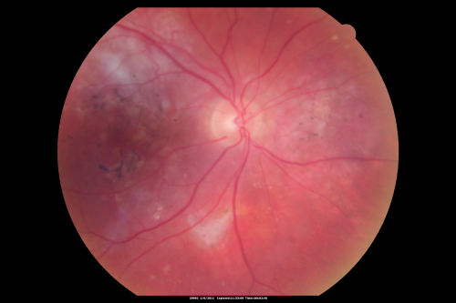 Polypoidal Choroidal Vasculopathy Right Eye - Disciform Scar Left Eye
84-year-old woman has polypoidal choroidal vasculopathy in both eyes with macular degeneration.  She has macular scars in both eyes and she remains with remarkably good vision in the right eye despite the scarring.  

VISUAL ACUITY:  OD 20/30,  OS 1/200

Avastin Rx OD
