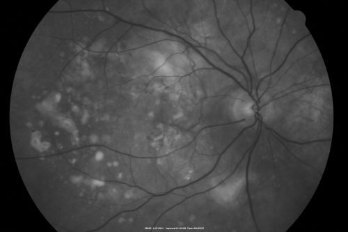 Polypoidal Choroidal Vasculopathy Right Eye - Disciform Scar Left Eye
84-year-old woman has polypoidal choroidal vasculopathy in both eyes with macular degeneration.  She has macular scars in both eyes and she remains with remarkably good vision in the right eye despite the scarring.  

VISUAL ACUITY:  OD 20/30,  OS 1/200

Avastin Rx OD
