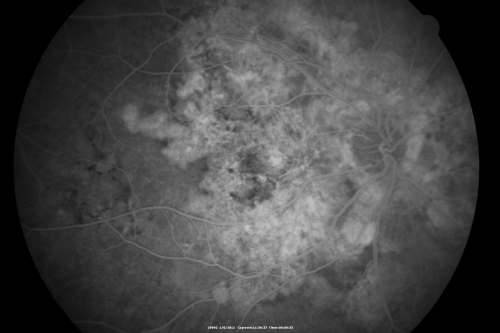 Polypoidal Choroidal Vasculopathy Right Eye - Disciform Scar Left Eye
84-year-old woman has polypoidal choroidal vasculopathy in both eyes with macular degeneration.  She has macular scars in both eyes and she remains with remarkably good vision in the right eye despite the scarring.  

VISUAL ACUITY:  OD 20/30,  OS 1/200

Avastin Rx OD
