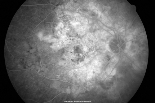 Polypoidal Choroidal Vasculopathy Right Eye - Disciform Scar Left Eye
84-year-old woman has polypoidal choroidal vasculopathy in both eyes with macular degeneration.  She has macular scars in both eyes and she remains with remarkably good vision in the right eye despite the scarring.  

VISUAL ACUITY:  OD 20/30,  OS 1/200

Avastin Rx OD
