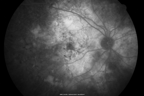 Polypoidal Choroidal Vasculopathy Right Eye - Disciform Scar Left Eye
84-year-old woman has polypoidal choroidal vasculopathy in both eyes with macular degeneration.  She has macular scars in both eyes and she remains with remarkably good vision in the right eye despite the scarring.  

VISUAL ACUITY:  OD 20/30,  OS 1/200

Avastin Rx OD
