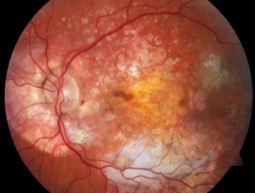 80 Year Old Woman Macular Degeneration Disciform Scar - Fibrosis
VA 20/100
