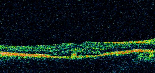Central Serous Retinopathy 41 year old woman with Vision Loss for One Year
41-year-old woman has chronic central serous retinopathy in the right eye with decreased vision in that eye for over a year.  Her vision has been waxing and waning and recently is getting worse.  Her vision in the left eye is fine.  

VISUAL ACUITY:  OD 20/40
