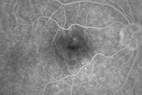 Central Serous Retinopathy 41 year old woman with Vision Loss for One Year
41-year-old woman has chronic central serous retinopathy in the right eye with decreased vision in that eye for over a year.  Her vision has been waxing and waning and recently is getting worse.  Her vision in the left eye is fine.  

VISUAL ACUITY:  OD 20/40

