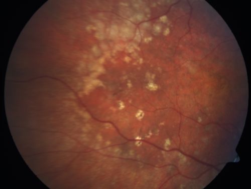 Basal Laminar Drusen - Cuticular Drusen - Equatorial Drusen - 70 Year Old Woman - Photo Equator
70 year old woman has had macular drusen since her thirties and she said her sister has a similar problem.  Recently the vision in the left eye has substantially declined. OD 20/16, OS 10/200.
