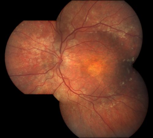 Basal Laminar Drusen - Cuticular Drusen - Equatorial Drusen - 70 Year Old Woman - Photo Montage Left Eye
70 year old woman has had macular drusen since her thirties and she said her sister has a similar problem.  Recently the vision in the left eye has substantially declined. OD 20/16, OS 10/200.

