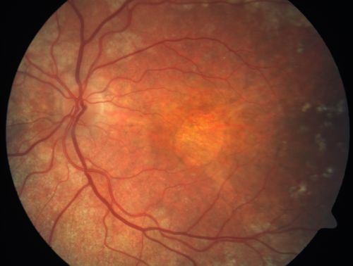 Basal Laminar Drusen - Cuticular Drusen - Equatorial Drusen - 70 Year Old Woman Fundus Photo - Geographic Atrophy
70 year old woman has had macular drusen since her thirties and she said her sister has a similar problem.  Recently the vision in the left eye has substantially declined. OD 20/16, OS 10/200.
