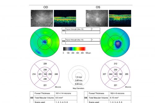 Basal Laminar Drusen - Cuticular Drusen - Equatorial Drusen - 70 Year Old Woman - OCT Map
70 year old woman has had macular drusen since her thirties and she said her sister has a similar problem.  Recently the vision in the left eye has substantially declined. OD 20/16, OS 10/200.
