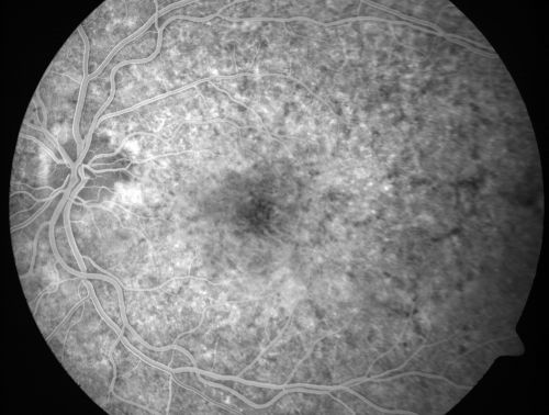 Basal Laminar Drusen - Cuticular Drusen - Equatorial Drusen - 70 Year Old Woman 
70 year old woman has had macular drusen since her thirties and she said her sister has a similar problem.  Recently the vision in the left eye has substantially declined. OD 20/16, OS 10/200.
