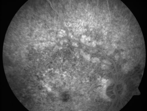 Basal Laminar Drusen - Cuticular Drusen - Equatorial Drusen - 70 Year Old Woman 
70 year old woman has had macular drusen since her thirties and she said her sister has a similar problem.  Recently the vision in the left eye has substantially declined. OD 20/16, OS 10/200.
