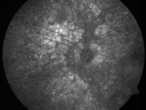 Basal Laminar Drusen - Cuticular Drusen - Equatorial Drusen - 70 Year Old Woman 
70 year old woman has had macular drusen since her thirties and she said her sister has a similar problem.  Recently the vision in the left eye has substantially declined. OD 20/16, OS 10/200.
