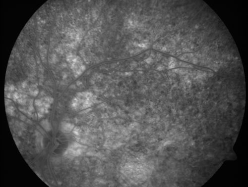 Basal Laminar Drusen - Cuticular Drusen - Equatorial Drusen - 70 Year Old Woman 
70 year old woman has had macular drusen since her thirties and she said her sister has a similar problem.  Recently the vision in the left eye has substantially declined. OD 20/16, OS 10/200.
