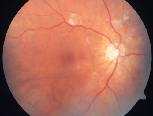 AIDS - HIV Retinopathy - Cotton Wool Spots
54-year-old woman HIV positive for 18 years.  Her CD4 count is currently less than 50 and she was hospitalized for pneumocystis carinii pneumonia 5 months ago. She has noticed just for the last few weeks a few blind spots in the paracentral vision.  Predominantly out of her right eye when she closes her left eye, she sees a few temporal blind spots. VA 20/25 in both eyes.  

