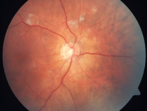 AIDS - HIV Retinopathy - Cotton Wool Spots
54-year-old woman HIV positive for 18 years.  Her CD4 count is currently less than 50 and she was hospitalized for pneumocystis carinii pneumonia 5 months ago. She has noticed just for the last few weeks a few blind spots in the paracentral vision.  Predominantly out of her right eye when she closes her left eye, she sees a few temporal blind spots. VA 20/25 in both eyes.  
