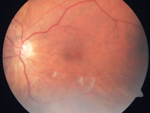 AIDS - HIV Retinopathy - Cotton Wool Spots
54-year-old woman HIV positive for 18 years.  Her CD4 count is currently less than 50 and she was hospitalized for pneumocystis carinii pneumonia 5 months ago. She has noticed just for the last few weeks a few blind spots in the paracentral vision.  Predominantly out of her right eye when she closes her left eye, she sees a few temporal blind spots. VA 20/25 in both eyes.  
