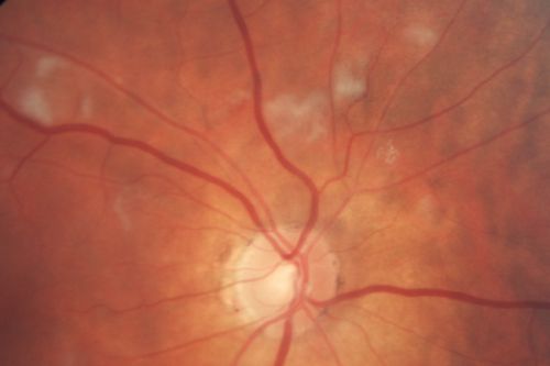 AIDS - HIV Retinopathy - Cotton Wool Spots
54-year-old woman HIV positive for 18 years.  Her CD4 count is currently less than 50 and she was hospitalized for pneumocystis carinii pneumonia 5 months ago. She has noticed just for the last few weeks a few blind spots in the paracentral vision.  Predominantly out of her right eye when she closes her left eye, she sees a few temporal blind spots. VA 20/25 in both eyes.  
