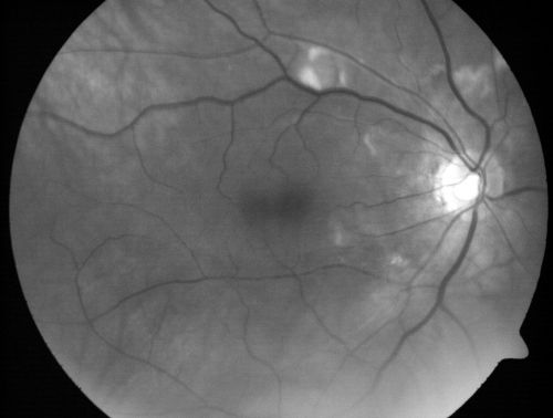 AIDS - HIV Retinopathy - Cotton Wool Spots
54-year-old woman HIV positive for 18 years.  Her CD4 count is currently less than 50 and she was hospitalized for pneumocystis carinii pneumonia 5 months ago. She has noticed just for the last few weeks a few blind spots in the paracentral vision.  Predominantly out of her right eye when she closes her left eye, she sees a few temporal blind spots. VA 20/25 in both eyes.  
