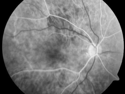 AIDS - HIV Retinopathy - Cotton Wool Spots
54-year-old woman HIV positive for 18 years.  Her CD4 count is currently less than 50 and she was hospitalized for pneumocystis carinii pneumonia 5 months ago. She has noticed just for the last few weeks a few blind spots in the paracentral vision.  Predominantly out of her right eye when she closes her left eye, she sees a few temporal blind spots. VA 20/25 in both eyes.  
