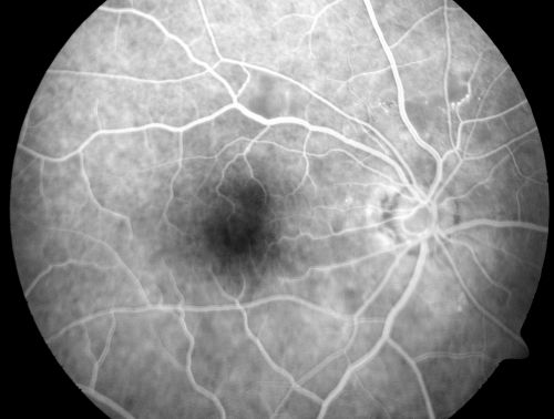 AIDS - HIV Retinopathy - Cotton Wool Spots
54-year-old woman HIV positive for 18 years.  Her CD4 count is currently less than 50 and she was hospitalized for pneumocystis carinii pneumonia 5 months ago. She has noticed just for the last few weeks a few blind spots in the paracentral vision.  Predominantly out of her right eye when she closes her left eye, she sees a few temporal blind spots. VA 20/25 in both eyes.  
