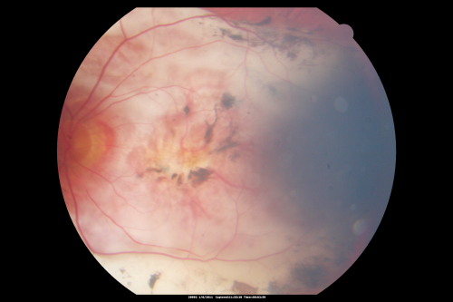Polypoidal Choroidal Vasculopathy Right Eye - Disciform Scar Left Eye
84-year-old woman has polypoidal choroidal vasculopathy in both eyes with macular degeneration.  She has macular scars in both eyes and she remains with remarkably good vision in the right eye despite the scarring.  

VISUAL ACUITY:  OD 20/30,  OS 1/200

Avastin Rx OD
