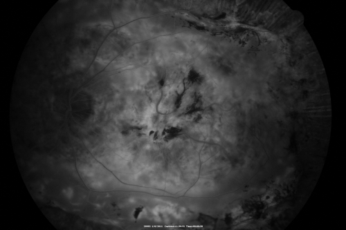 Polypoidal Choroidal Vasculopathy Right Eye - Disciform Scar Left Eye
84-year-old woman has polypoidal choroidal vasculopathy in both eyes with macular degeneration.  She has macular scars in both eyes and she remains with remarkably good vision in the right eye despite the scarring.  

VISUAL ACUITY:  OD 20/30,  OS 1/200

Avastin Rx OD

