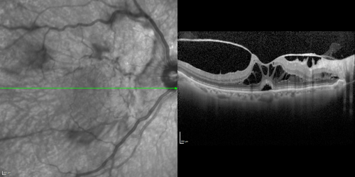 Vitreomacular Traction 3 months - 20/60 vision - Fellow Eye Normal - 80 Year Old Man SD - OCT
80-year-old man has a macular pucker in the right eye with vitreomacular traction and vision loss for 3 months.  His vision seems about stable to him.   OD 20/60.
