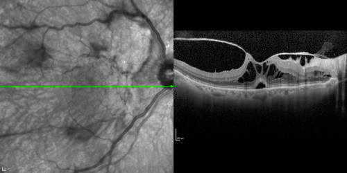 Vitreomacular Traction 3 months - 20/60 vision - Fellow Eye Normal - 80 Year Old Man - SD - OCT
80-year-old man has a macular pucker in the right eye with vitreomacular traction and vision loss for 3 months.  His vision seems about stable to him.   OD 20/60.

