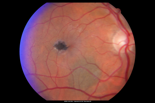 Juxtafoveal Telangiectasis - MacTel - Group 2a - Stage IV - Pigment Plaque 89 Year Old Man (Also Nevus)
89-year-old man has stage IV  juxtafoveal retinal telangiectasis in both eyes with background diabetic retinopathy.  His vision is stable since he was here last which is about 6 months ago. OD 20/50,  OS 20/70.

