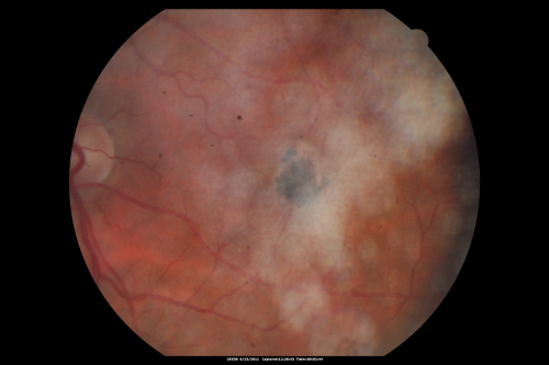 Juxtafoveal Telangiectasis - MacTel - Group 2a - Stage IV - Pigment Plaque 89 Year Old Man
89-year-old man has stage IV  juxtafoveal retinal telangiectasis in both eyes with background diabetic retinopathy.  His vision is stable since he was here last which is about 6 months ago. OD 20/50,  OS 20/70.
