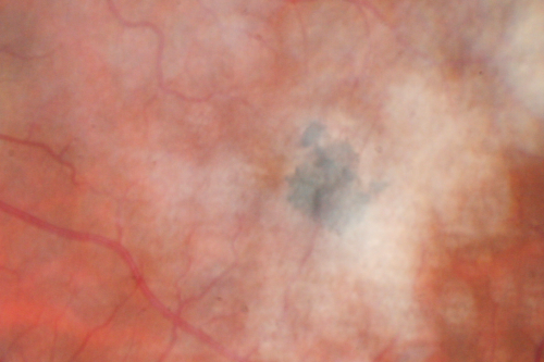 Juxtafoveal Telangiectasis - MacTel - Group 2a - Stage IV - Pigment Plaque 89 Year Old Man - Asteroid Hyalosis
89-year-old man has stage IV  juxtafoveal retinal telangiectasis in both eyes with background diabetic retinopathy.  His vision is stable since he was here last which is about 6 months ago. OD 20/50,  OS 20/70.
