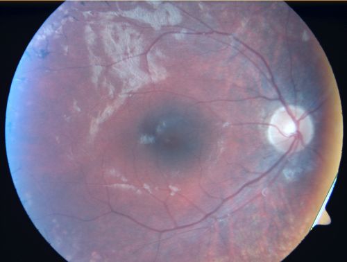 Retinitis Pigmentosa - Leber's Congenital Amaurosis - 7 Year Old Child - Right Eye
7-year-old child who trips over things that the other children do not have trouble seeing.  She is the only person in the family tree that the mother knows has any vision problems. Vision is 20/20 in each eye
