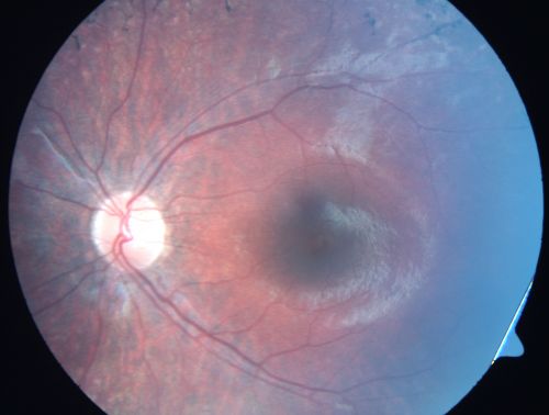 Retinitis Pigmentosa - Leber's Congenital Amaurosis - 7 Year Old Child - Left Eye
7-year-old child who trips over things that the other children do not have trouble seeing.  She is the only person in the family tree that the mother knows has any vision problems. Vision is 20/20 in each eye
