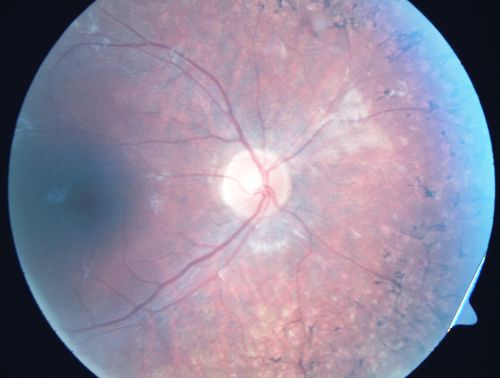 Retinitis Pigmentosa - Leber's Congenital Amaurosis - 7 Year Old Child
7-year-old child who trips over things that the other children do not have trouble seeing.  She is the only person in the family tree that the mother knows has any vision problems. Vision is 20/20 in each eye
