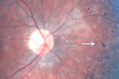Retinitis Pigmentosa - Leber's Congenital Amaurosis - 7 Year Old Child -Fundus Photo Right Eye - Periphery
7-year-old child who trips over things that the other children do not have trouble seeing.  She is the only person in the family tree that the mother knows has any vision problems. Vision is 20/20 in each eye
