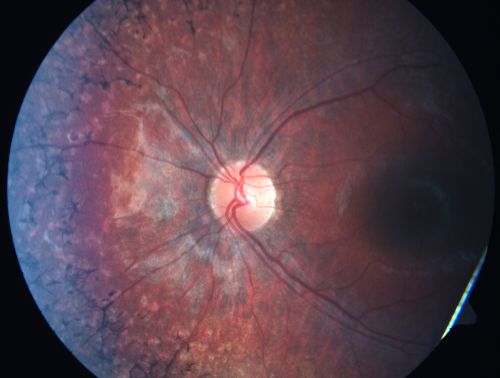 Retinitis Pigmentosa - Leber's Congenital Amaurosis - 7 Year Old Child
7-year-old child who trips over things that the other children do not have trouble seeing.  She is the only person in the family tree that the mother knows has any vision problems. Vision is 20/20 in each eye
