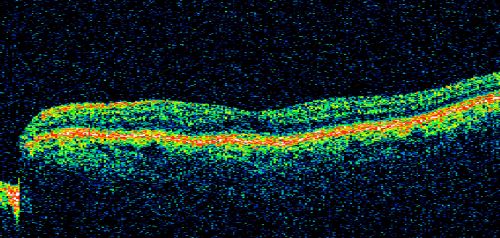 Pattern Dystrophy - Adult Vitelliform Dystrophy - Macular Degeneration
 78 Year Old Woman with vision has diminished in the right eye over the past couple of years, but the diminishment has been slow.
 20/60+1 OD, 20/25 OS
