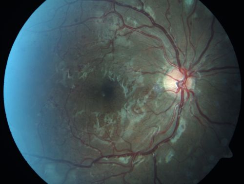 Capillary Non-Perfusion - Severe Non-Proliferative (Background) Diabetic Retinopathy - Type I - 20 Year Old Man Diabetic 16 years
20 year old diabetic with poor vision for the past three or four years. He has been diabetic for sixteen years and hemoglobin A1C of 10.0.   20/25 OD, 20/30 OS.  
