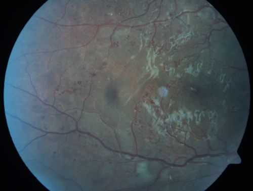 Capillary Non-Perfusion - Severe Non-Proliferative (Background) Diabetic Retinopathy - Type I - 20 Year Old Man Diabetic 16 years
20 year old diabetic with poor vision for the past three or four years. He has been diabetic for sixteen years and hemoglobin A1C of 10.0.   20/25 OD, 20/30 OS.  
