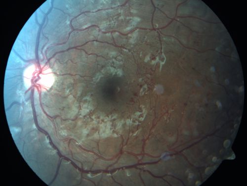 Capillary Non-Perfusion - Severe Non-Proliferative (Background) Diabetic Retinopathy - Type I - 20 Year Old Man Diabetic 16 years
20 year old diabetic with poor vision for the past three or four years. He has been diabetic for sixteen years and hemoglobin A1C of 10.0.   20/25 OD, 20/30 OS.  
