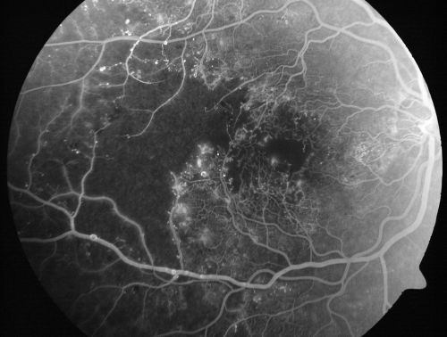 Capillary Non-Perfusion - Severe Non-Proliferative (Background) Diabetic Retinopathy - Type I - 20 Year Old Man Diabetic 16 years
20 year old diabetic with poor vision for the past three or four years. He has been diabetic for sixteen years and hemoglobin A1C of 10.0.   20/25 OD, 20/30 OS.  
