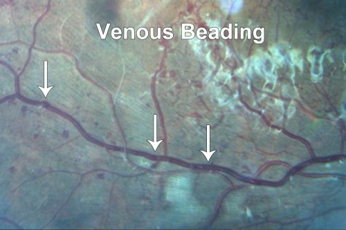 Capillary Non-Perfusion - Severe Non-Proliferative (Background) Diabetic Retinopathy - Type I - 20 Year Old Man Diabetic 16 years
20 year old diabetic with poor vision for the past three or four years. He has been diabetic for sixteen years and hemoglobin A1C of 10.0.   20/25 OD, 20/30 OS.  
