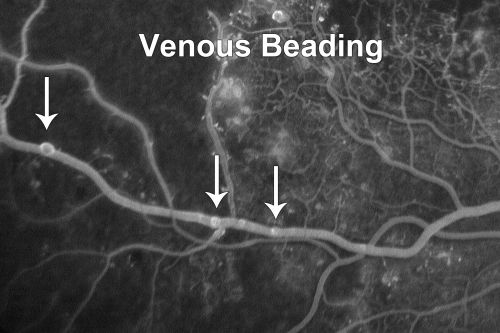 Capillary Non-Perfusion - Severe Non-Proliferative (Background) Diabetic Retinopathy - Type I - 20 Year Old Man Diabetic 16 years
20 year old diabetic with poor vision for the past three or four years. He has been diabetic for sixteen years and hemoglobin A1C of 10.0.   20/25 OD, 20/30 OS.  
