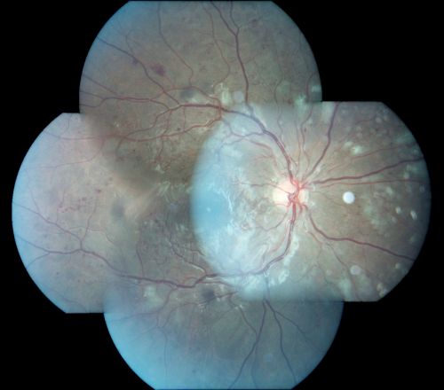 Capillary Non-Perfusion - Severe Non-Proliferative (Background) Diabetic Retinopathy - Type I - 20 Year Old Man Diabetic 16 years
20 year old diabetic with poor vision for the past three or four years. He has been diabetic for sixteen years and hemoglobin A1C of 10.0.   20/25 OD, 20/30 OS.  
