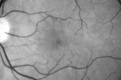 Radiation Retinopathy and Macular Pucker 4 years following Brachytherapy (Plaque) for Nasal Melanoma
67-year-old woman has a macular pucker in the left eye.  She had radiation for a melanoma in that eye 4 years aog.  She had cataract surgery 2 years ago and a posterior sub-Tenon Kenalog injection in 7 months ago.  Her vision in the left eye is hazy and she has trouble seeing out of it.  VA  OS 20/70. 
