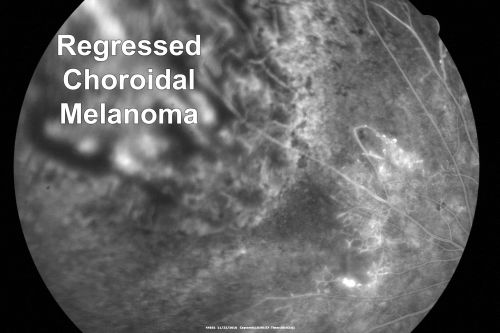 Radiation Retinopathy and Macular Pucker 4 years following Brachytherapy (Plaque) for Nasal Melanoma
67-year-old woman has a macular pucker in the left eye.  She had radiation for a melanoma in that eye 4 years aog.  She had cataract surgery 2 years ago and a posterior sub-Tenon Kenalog injection in 7 months ago.  Her vision in the left eye is hazy and she has trouble seeing out of it.  VA  OS 20/70. 
