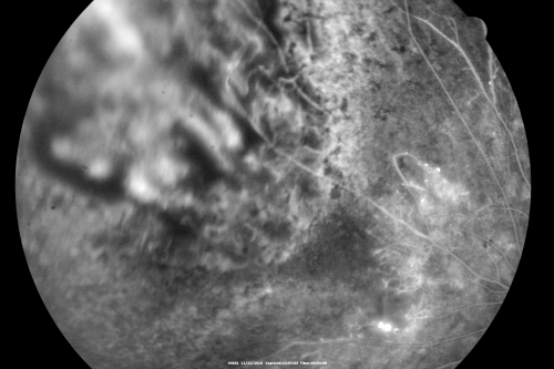 Radiation Retinopathy and Macular Pucker 4 years following Brachytherapy (Plaque) for Nasal Melanoma
67-year-old woman has a macular pucker in the left eye.  She had radiation for a melanoma in that eye 4 years aog.  She had cataract surgery 2 years ago and a posterior sub-Tenon Kenalog injection in 7 months ago.  Her vision in the left eye is hazy and she has trouble seeing out of it.  VA  OS 20/70. 
